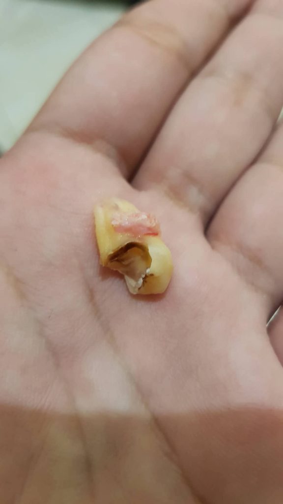 Wisdom Tooth Removed