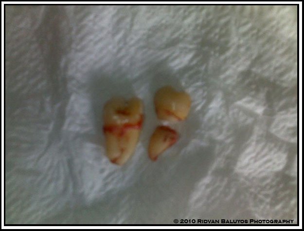 Wisdom Tooth Removed
