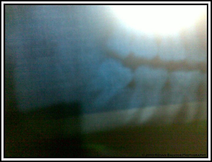 Impacted Wisdom Tooth X-Ray